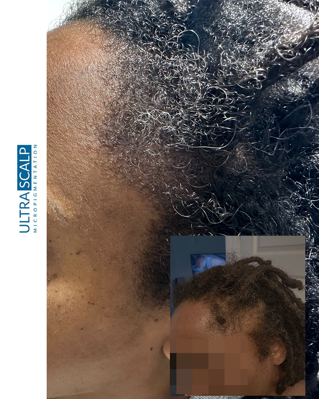 scalp micropigmentation for alopecia