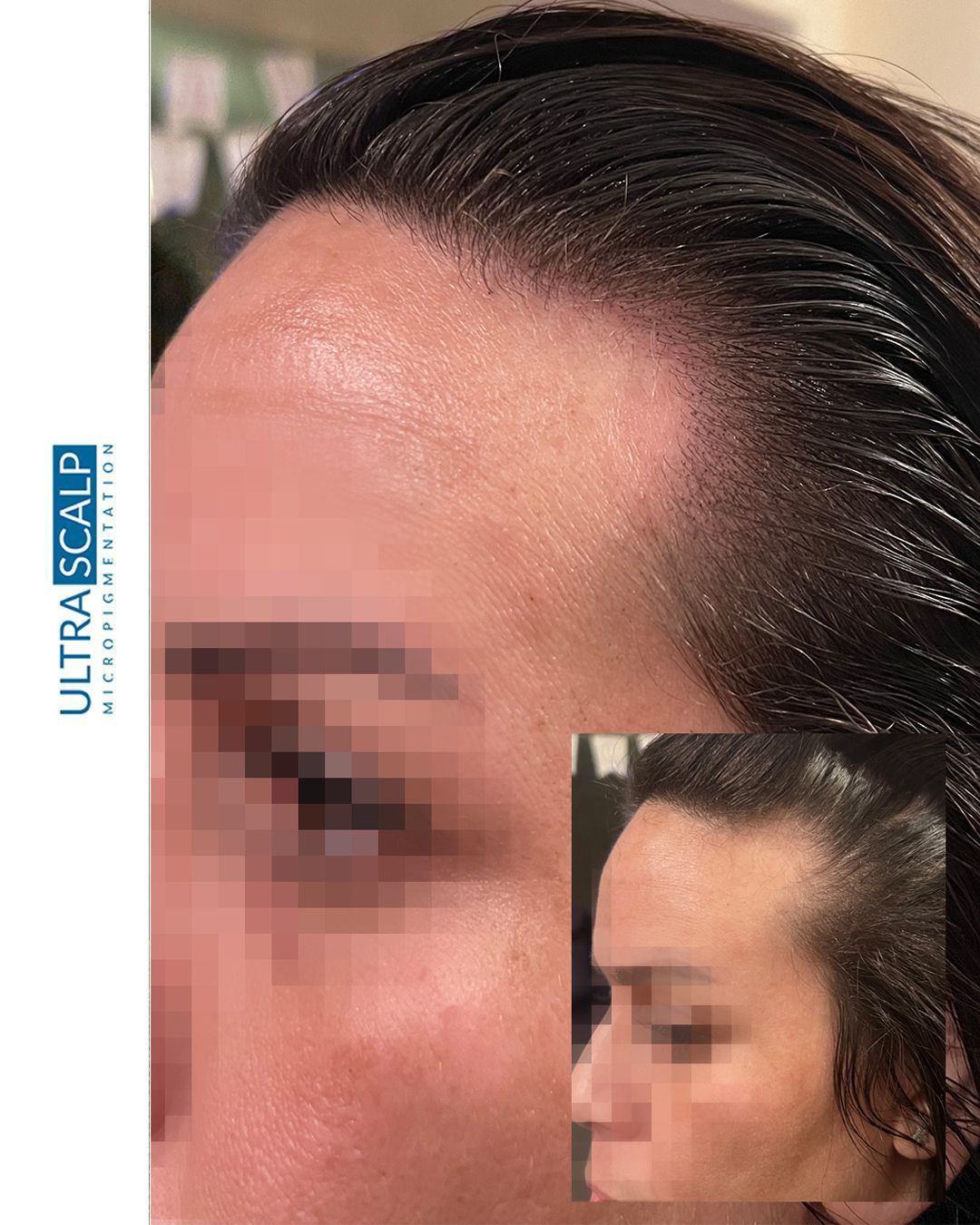 scalp micropigmentation Thin hairline