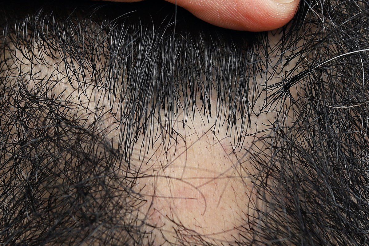 Benefits of hair tattoos for bald spots