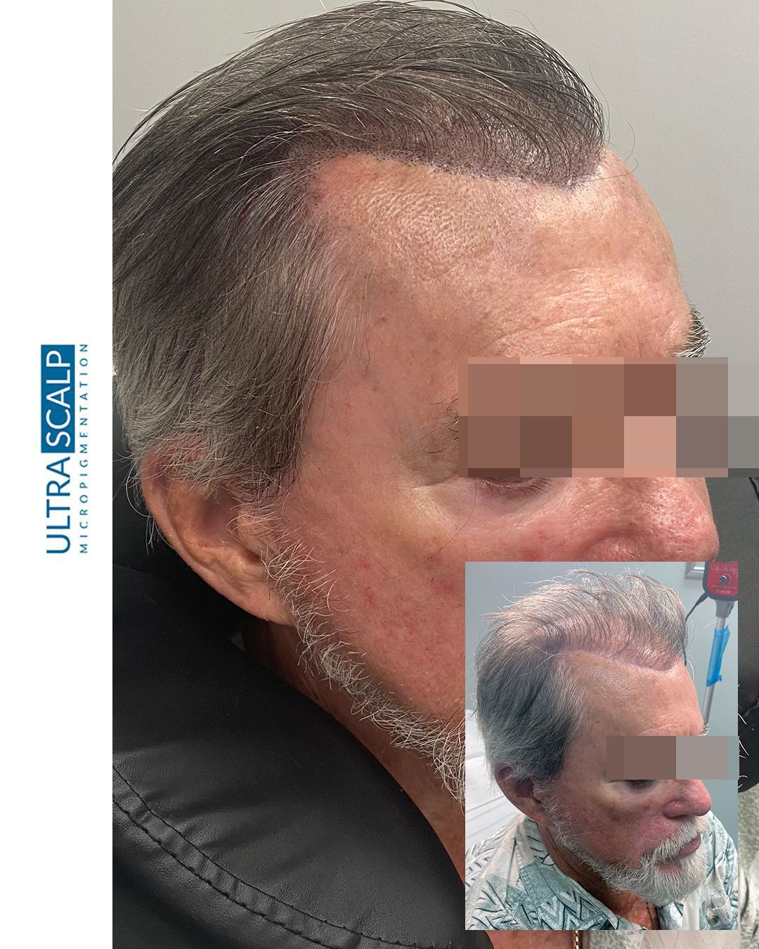 scalp micropigmentation after hair transplant Tampa