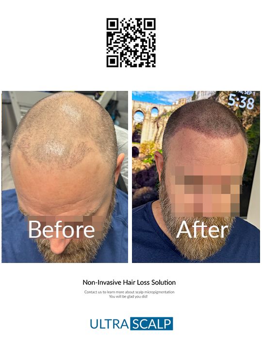 Non Surgical Hair Loss Alternatives In Tampa Top 5 Treatments 3900