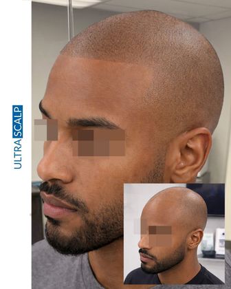 scalp micropigmentation after hair transplant Tampa