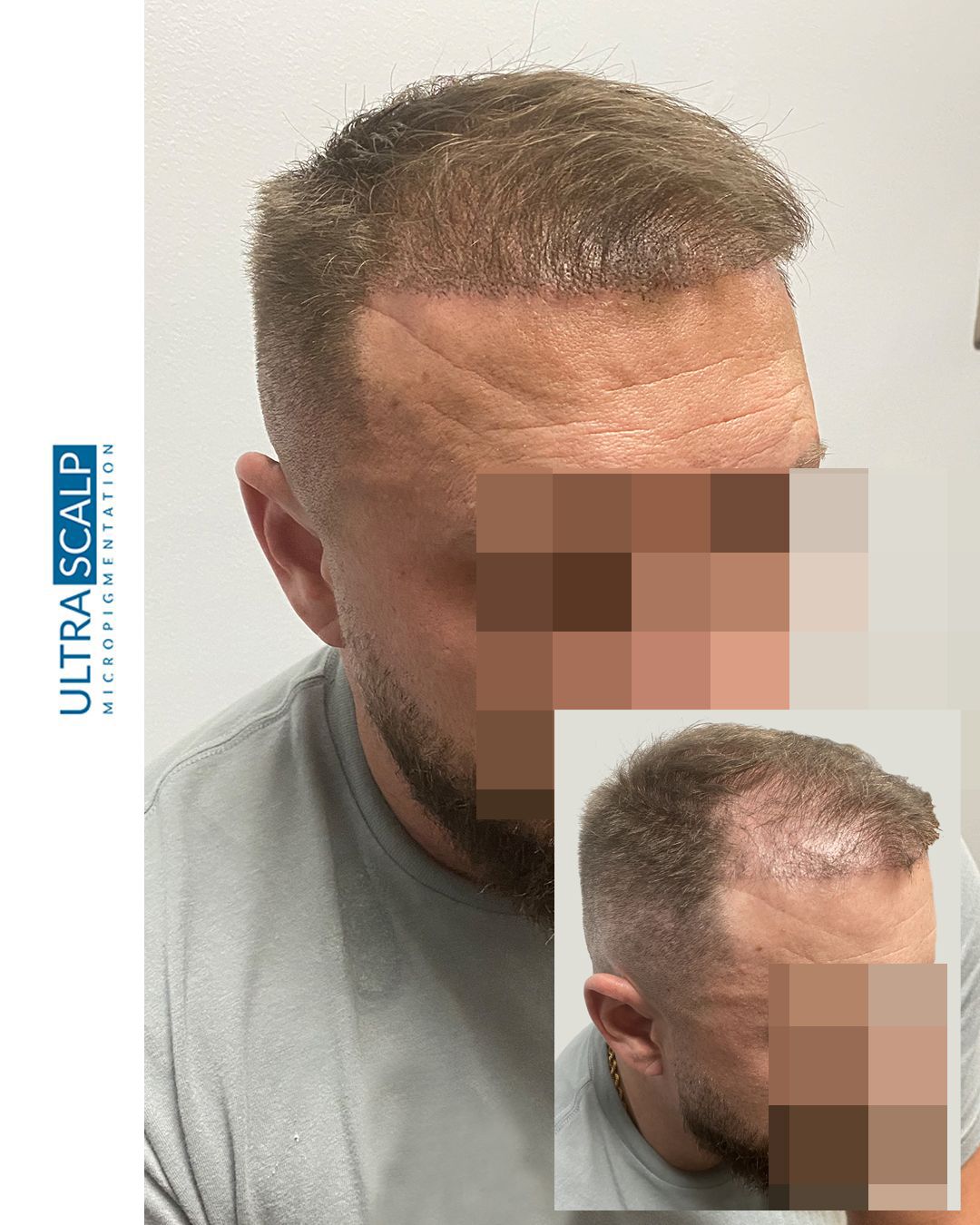 Hair Transplant Scar Cover Up with SMP Tampa