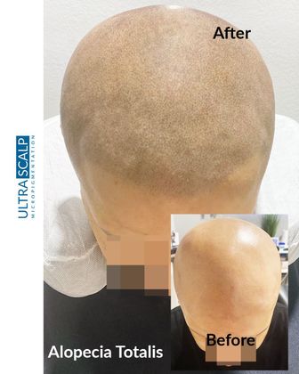 SMP For 
Alopecia Totalis Scalp Micropigmentation