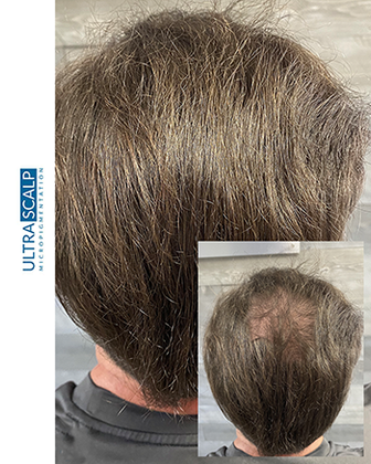 scalp micropigmentation for men after  Hair Transplant