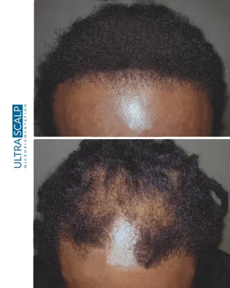 Fue Hair Tranplant with Scalp Micropigmentation