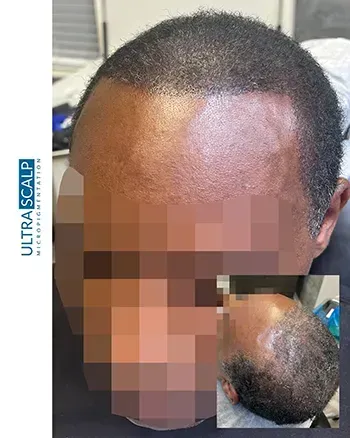 scalp micropigmentation Density tampa