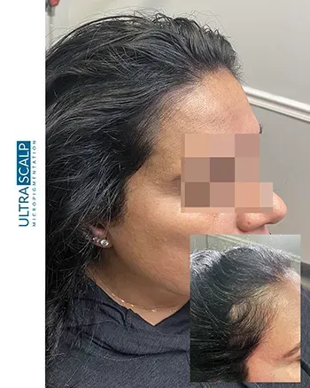 scalp micropigmentation for females with hair loss