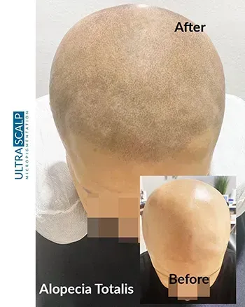 scalp micropigmentation barber style hairline Tampa