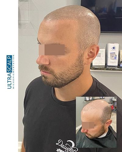 Scalp Micropigmentation Before And After (Actual Client) scalp micropigmentation thinning hair