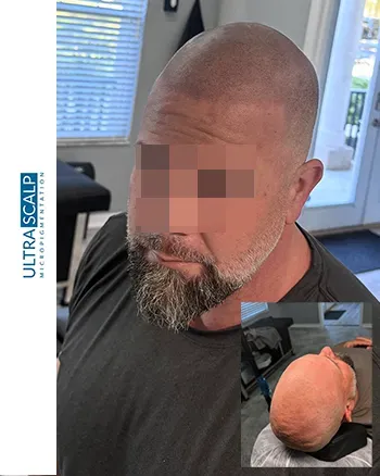 scalp micropigmentation for fixing hairline Shaved head look