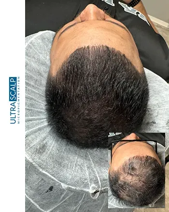 Scalp Micropigmentation For Long Hair (SMP)