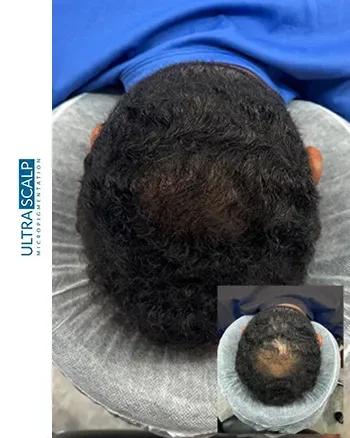 Scalp Micropigmentation For Long Hair (SMP)