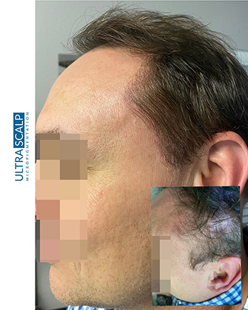 Scalp Micropigmentation For Thin Hairline Before And After (Actual Client)
