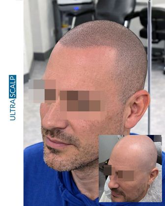 scalp micropigmentation for females with hair loss