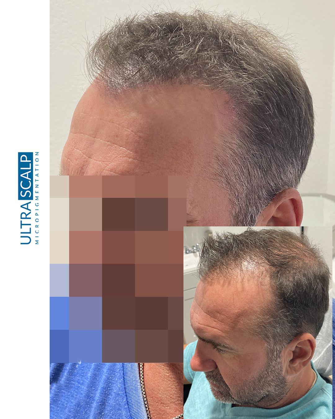 Scalp Micropigmentation Near Me