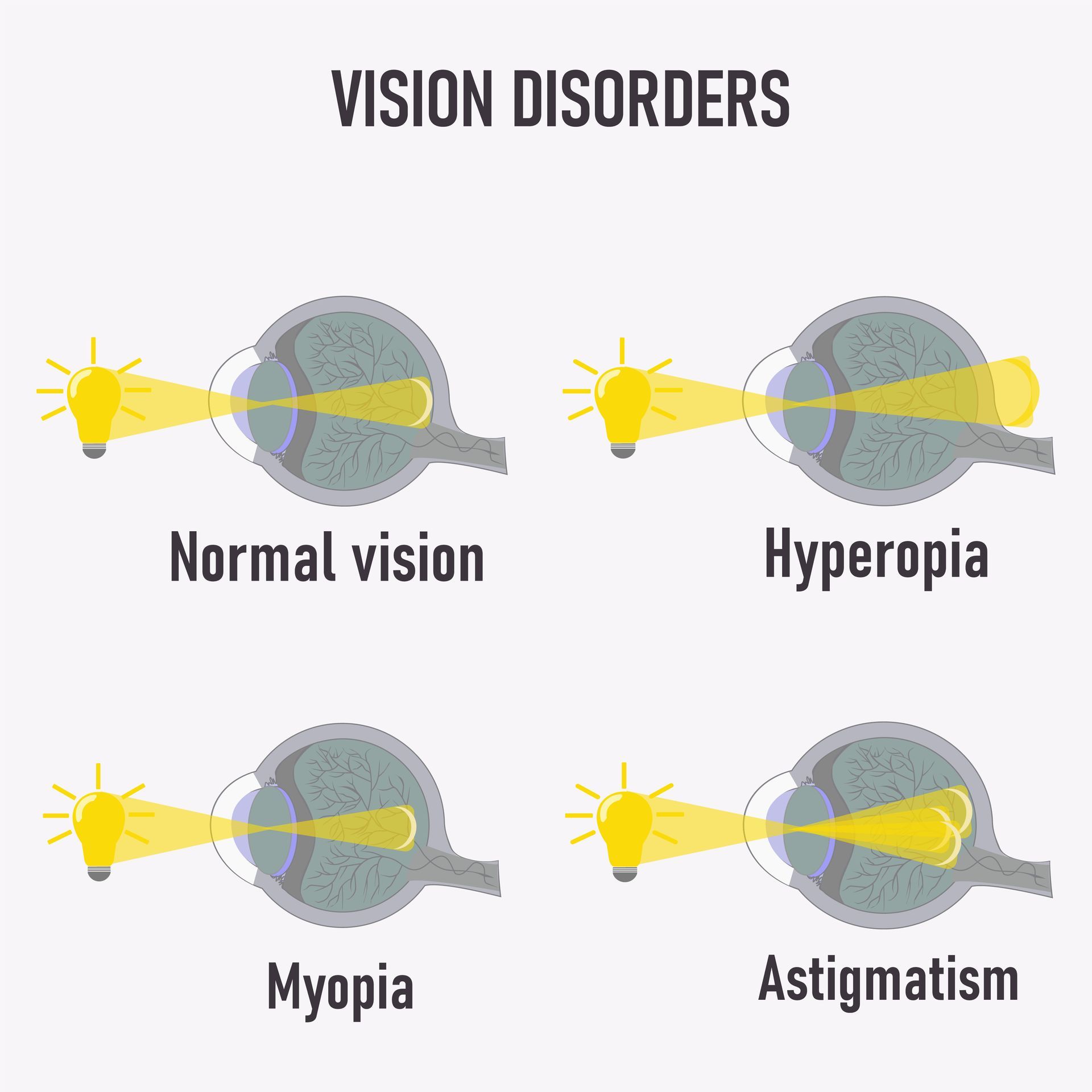 Diagram showing how light focuses in eyes with normal vision, hyperopia, myopia, and astigmatism.
