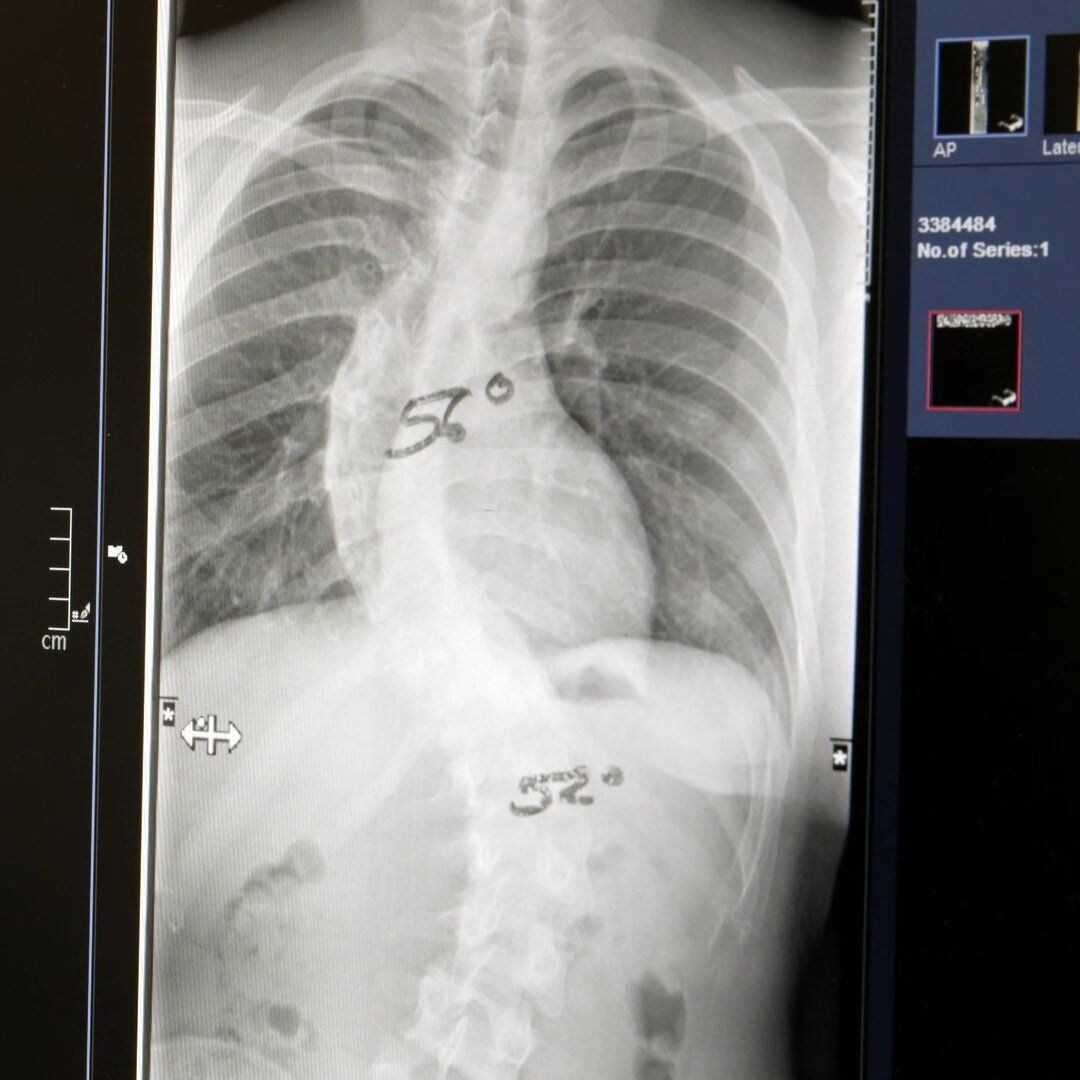 Skoliose Therapie Urban Spine Dr Nadja Jiresch 1010 Wien
