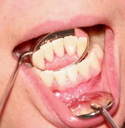 Periodontologinis gydymas - Po