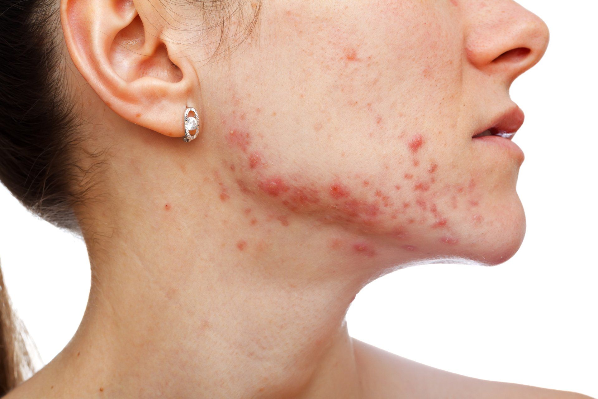 a woman with a lot of acne