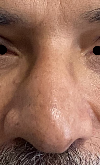 nose after treatment