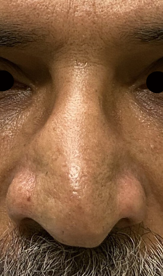 nose before treatment