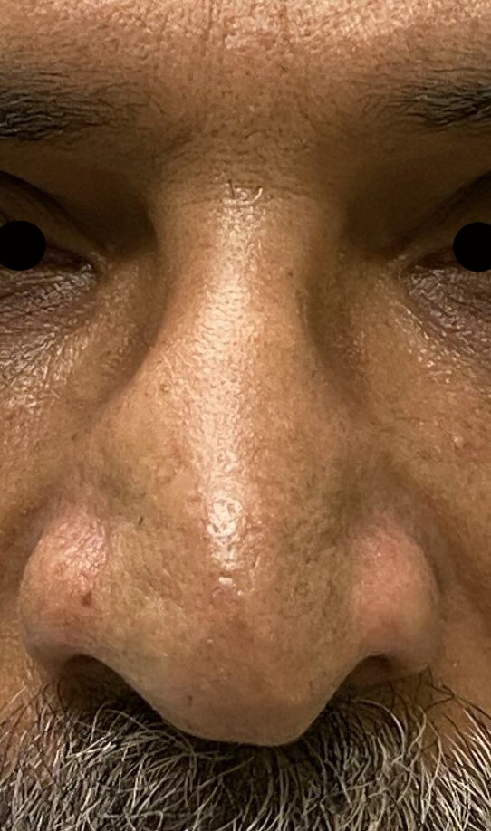 nose before treatment