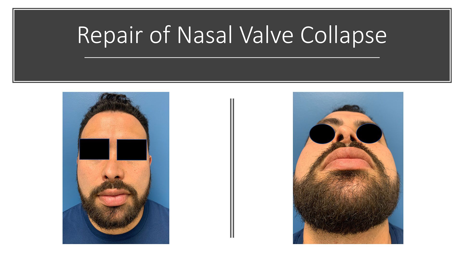 Repair of Nasal Valve Collapse After