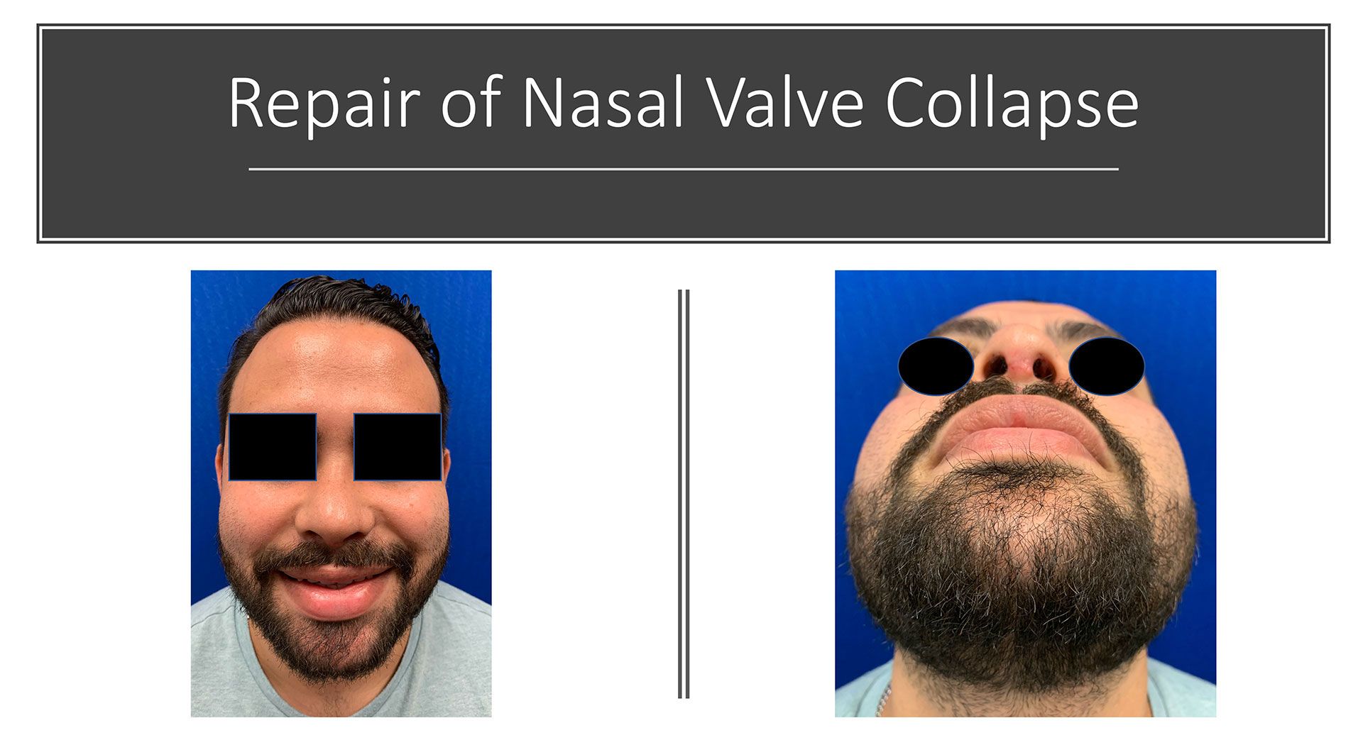 Repair of Nasal Valve Collapse Before