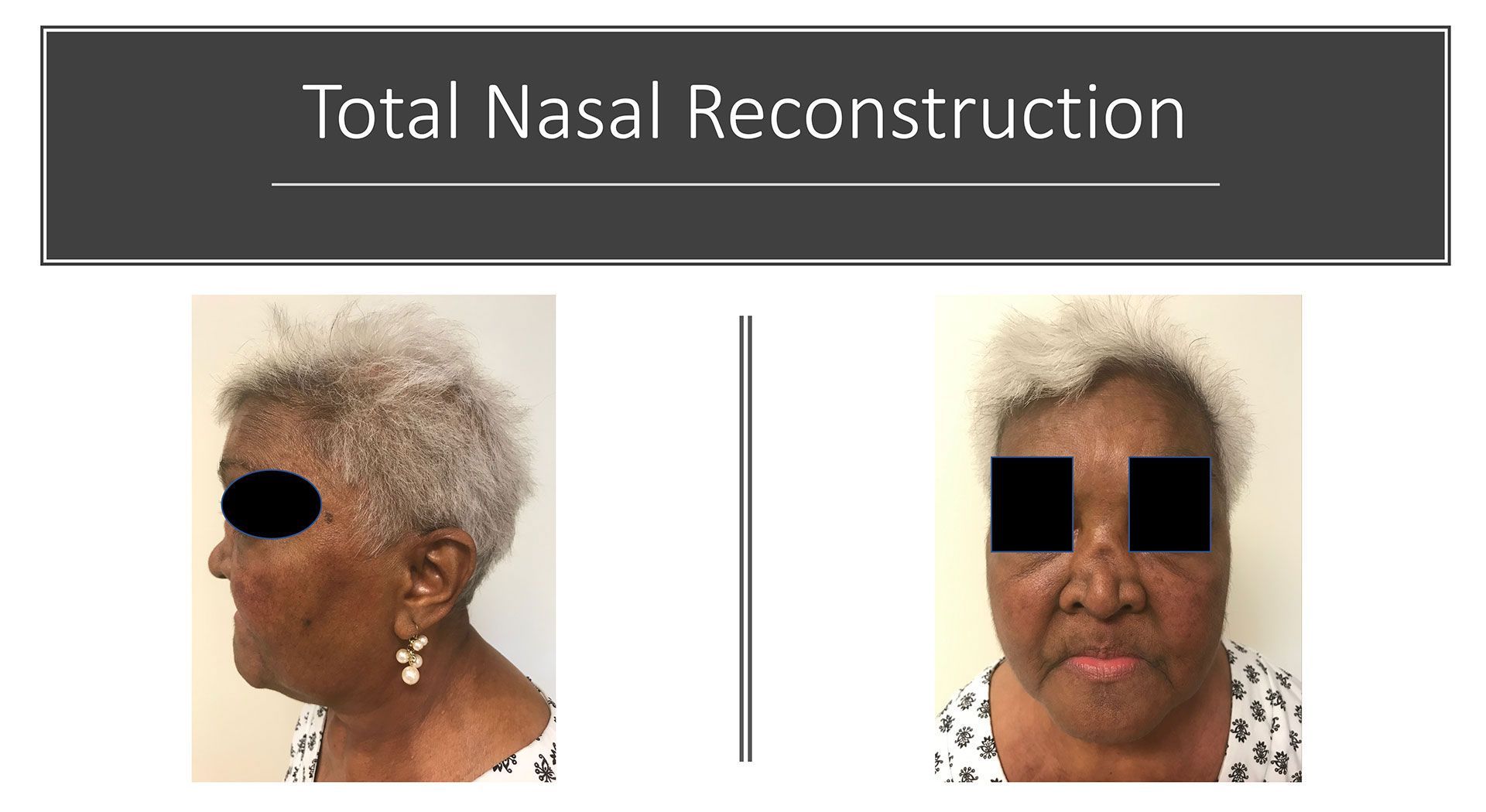 Total Nasal Reconstruction After