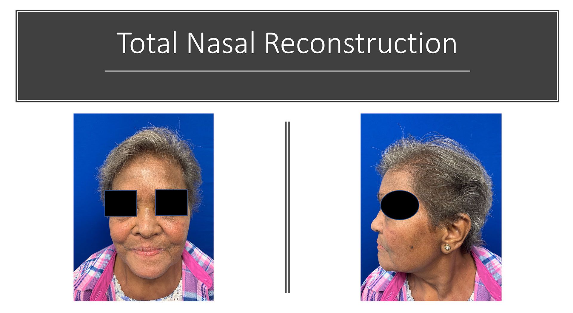 Total Nasal Reconstruction Before