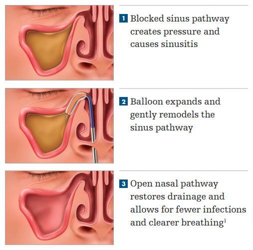 Sinus drainage online