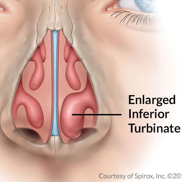 Enlarged Turbinate Picture