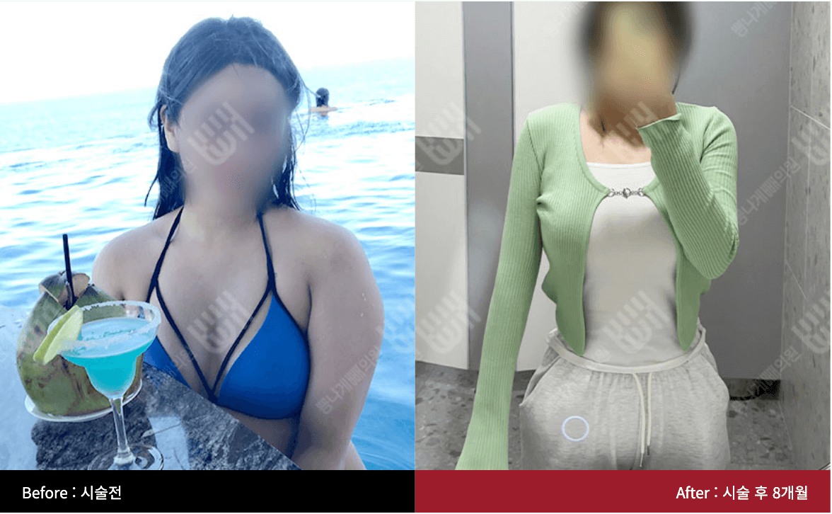 팔지방흡입