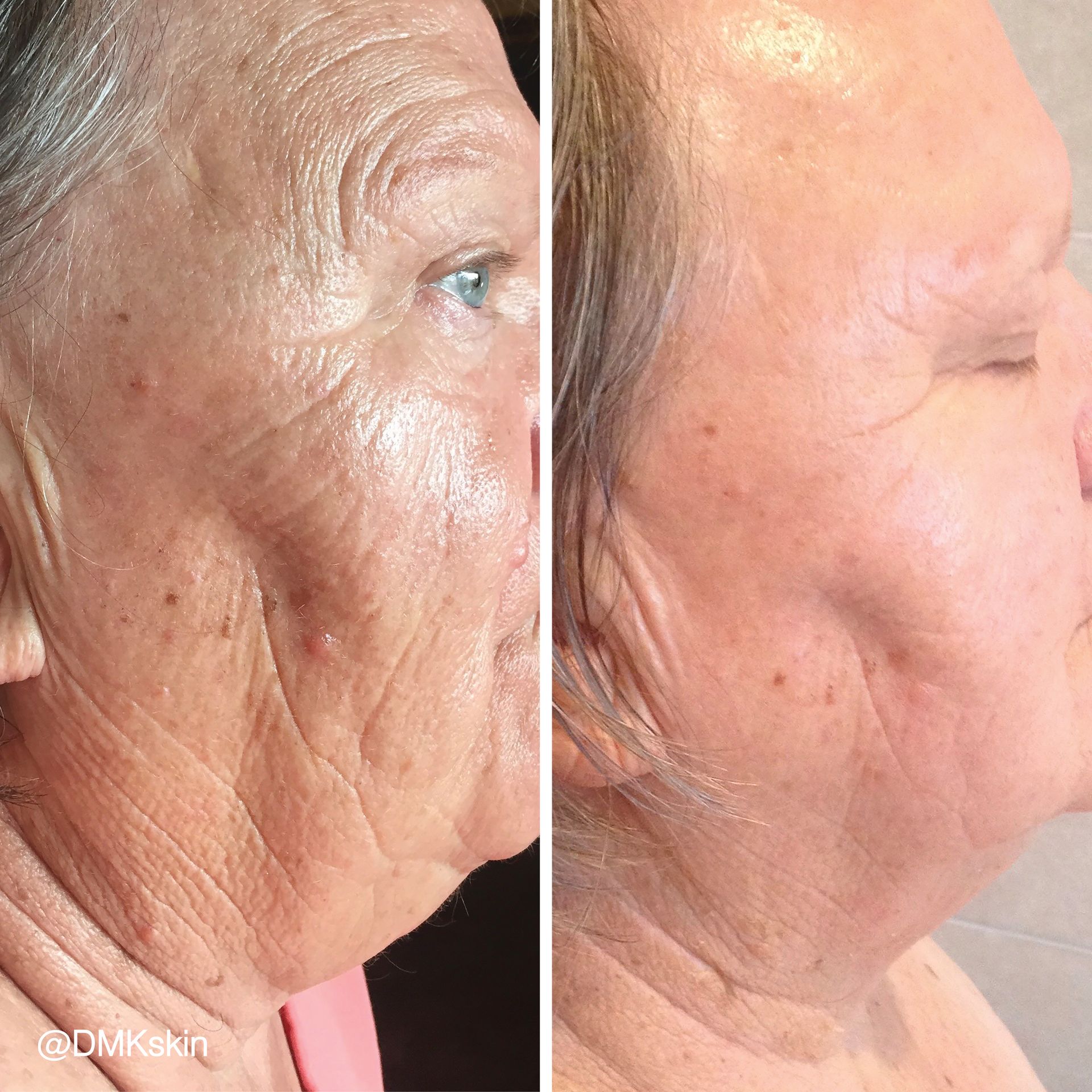 A before and after photo of an older woman 's face.