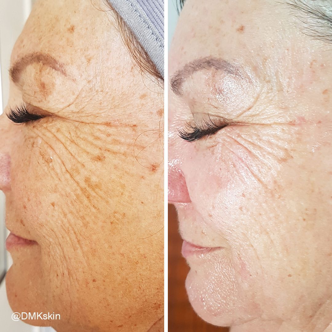 A before and after photo of a woman 's face.