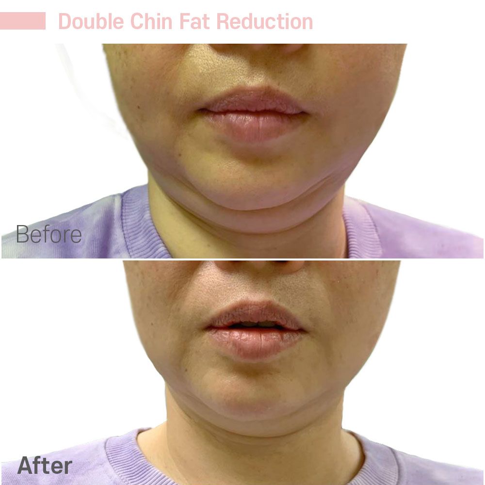 Before And After Forty Seven — Tustin, CA — RoseK Medical