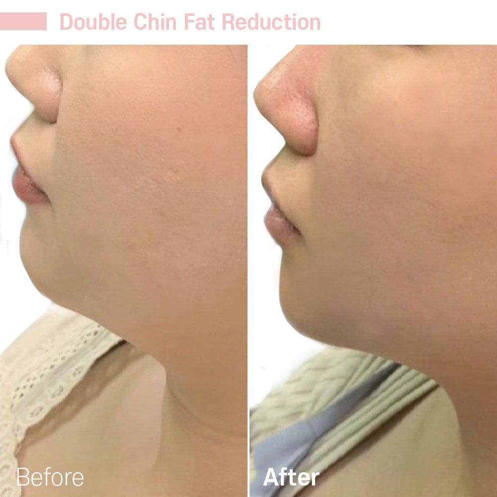 Before And After Forty Four — Tustin, CA — RoseK Medical