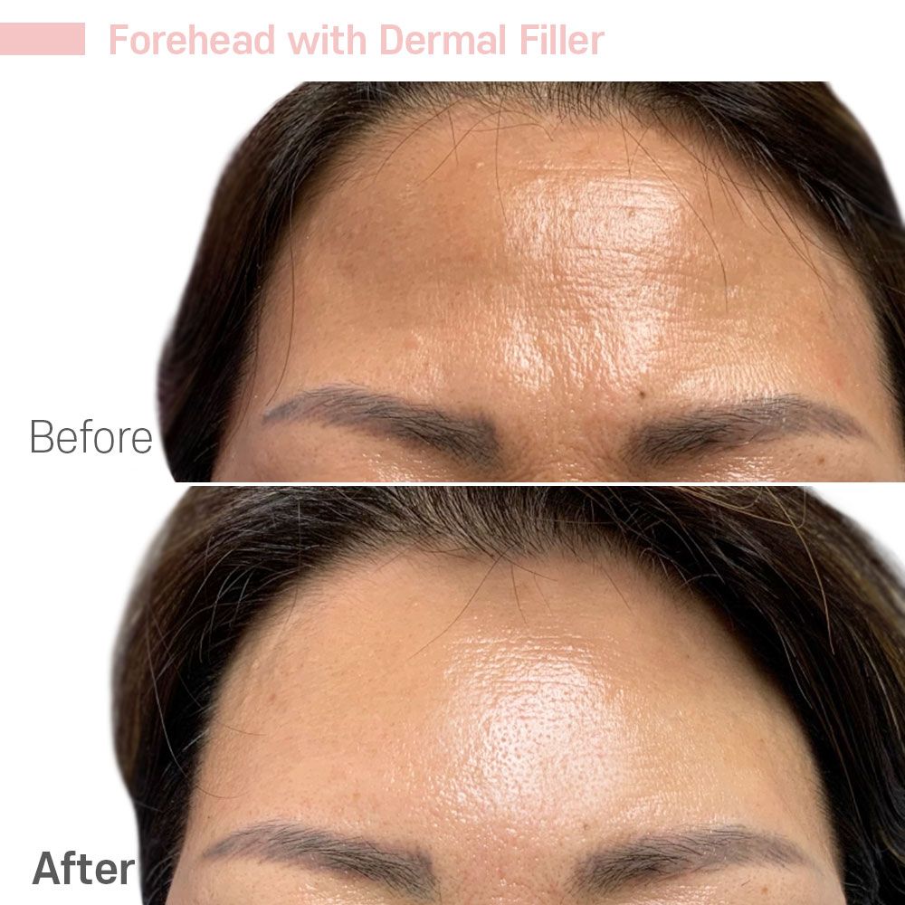 Before And After Thirty Nine — Tustin, CA — RoseK Medical