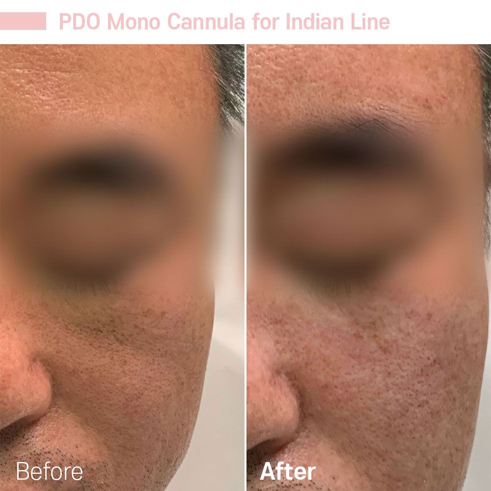 Before And After Thirty Four — Tustin, CA — RoseK Medical