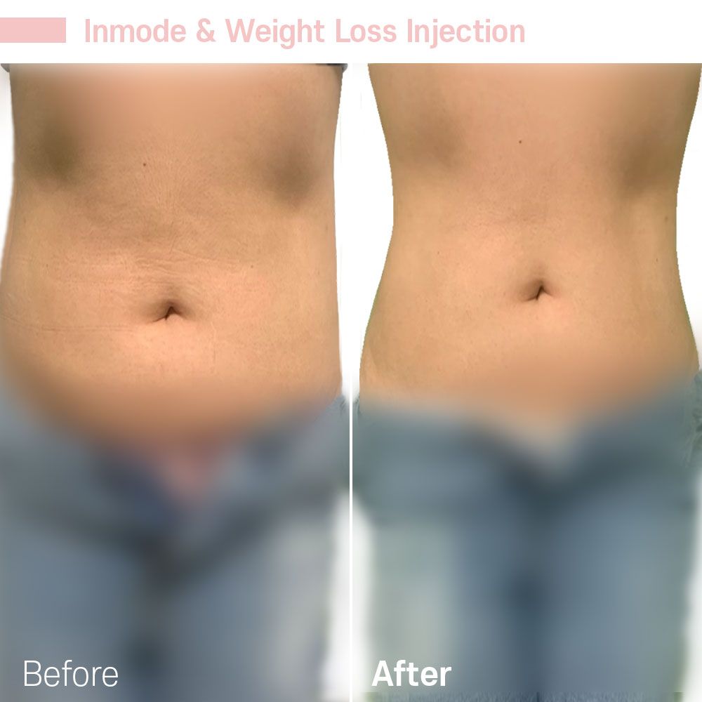 Before And After Thirty One — Tustin, CA — RoseK Medical