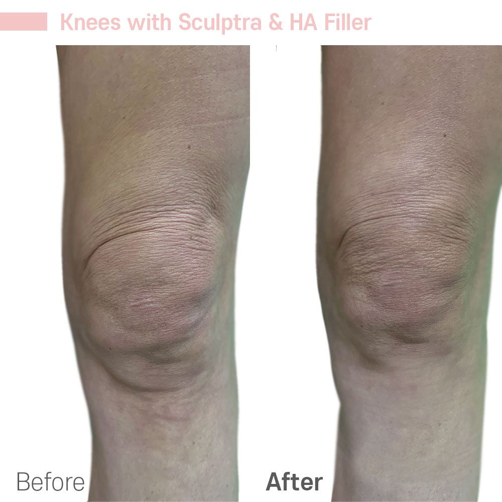 Before And After Twenty Eight — Tustin, CA — RoseK Medical