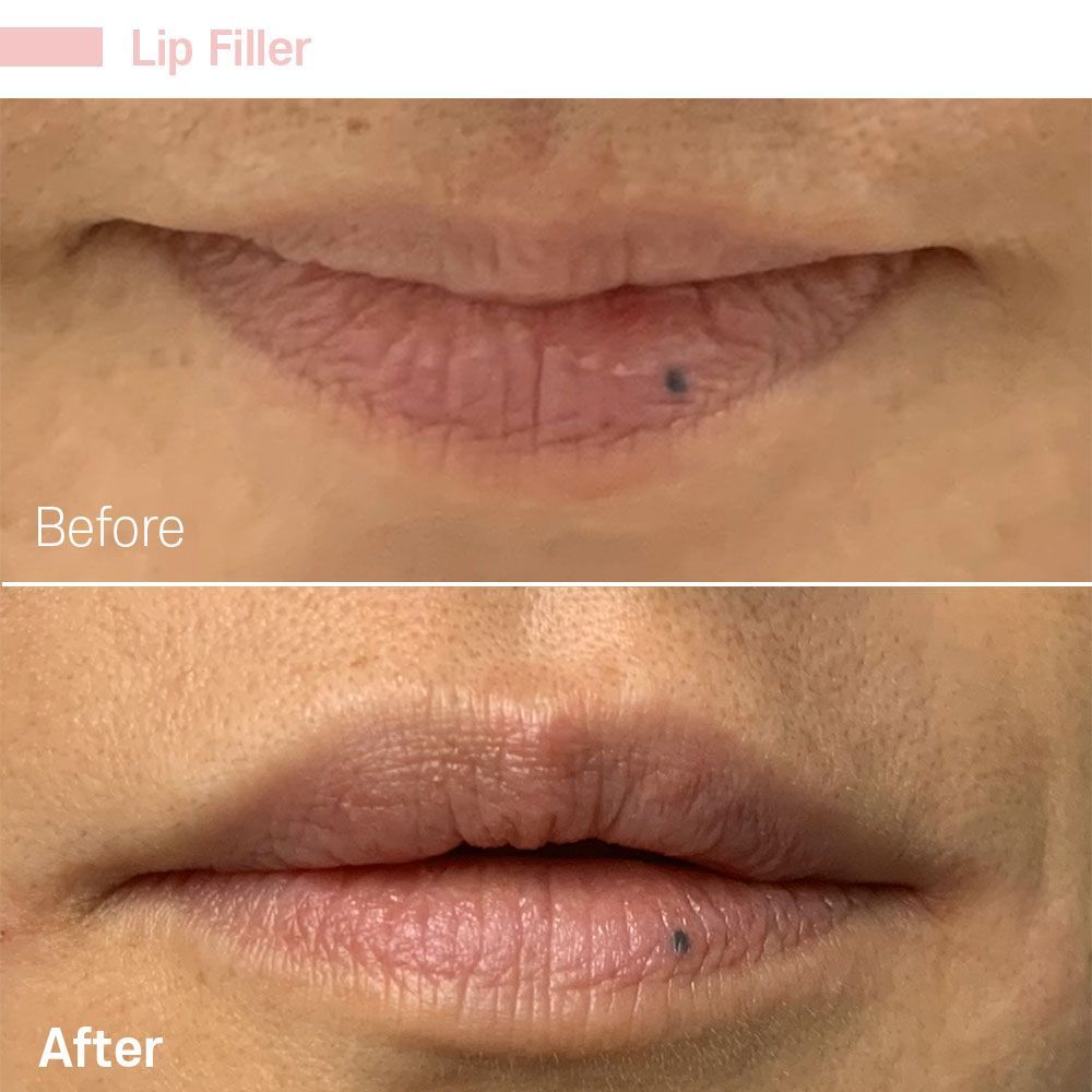 Before And After Twenty Six — Tustin, CA — RoseK Medical