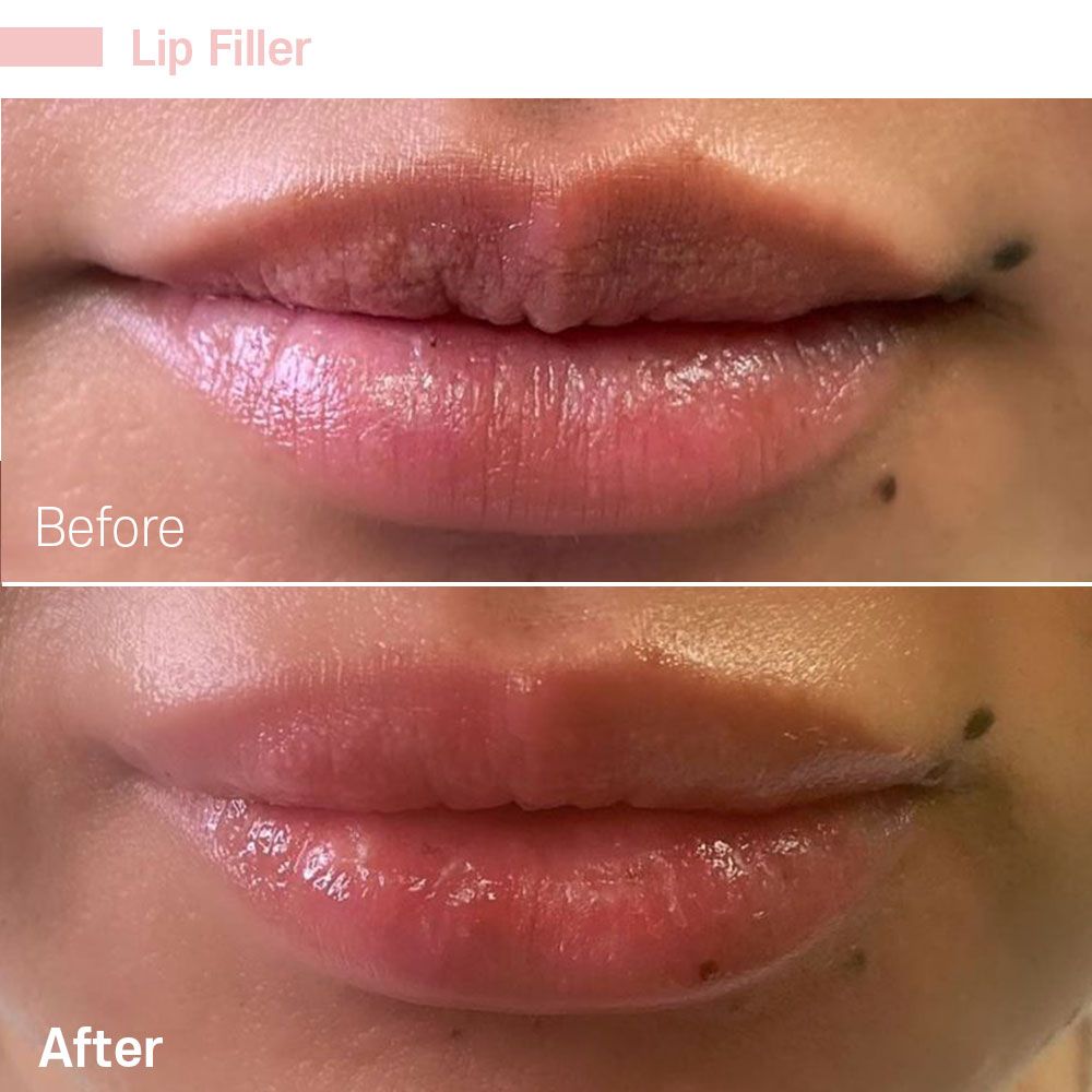 Before And After Twenty Four — Tustin, CA — RoseK Medical