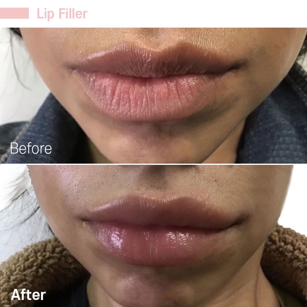 Before And After Twenty Three — Tustin, CA — RoseK Medical