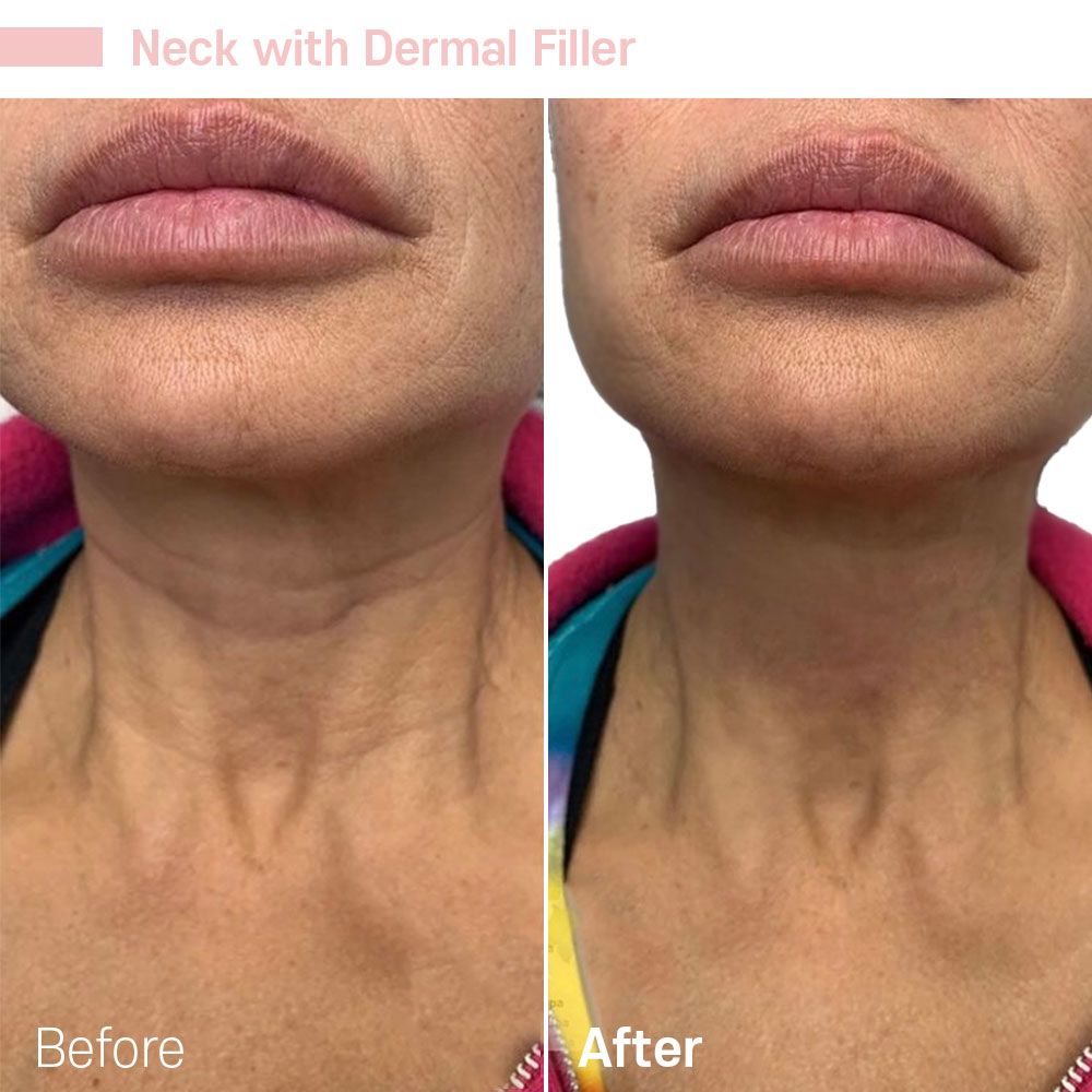 Beautiful Forehead Transformation — Tustin, CA — RoseK Medical