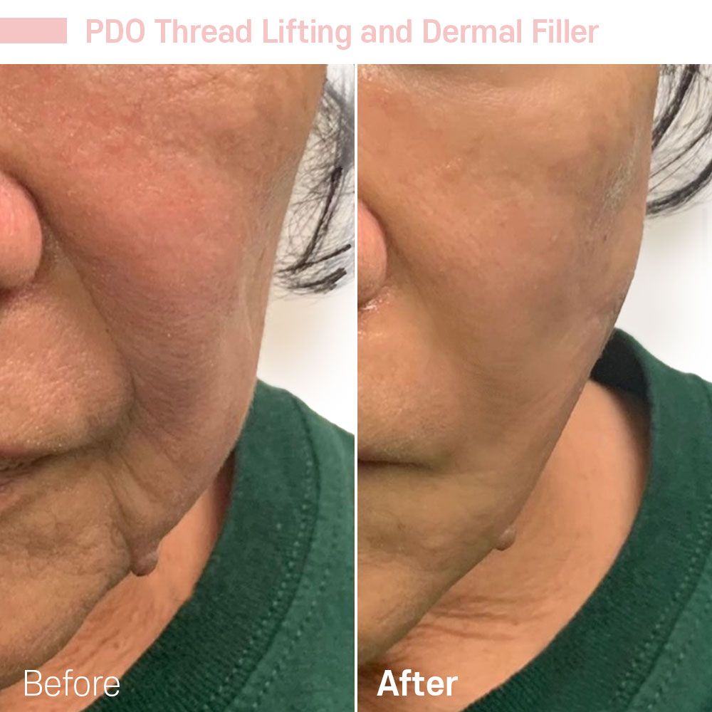 Before And After Eight — Tustin, CA — RoseK Medical