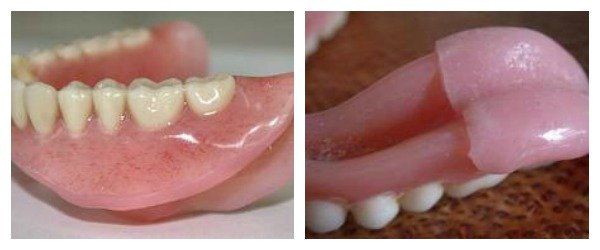 Dentures Reline — Burleigh Denture Clinic in Burleigh Heads, QLD
