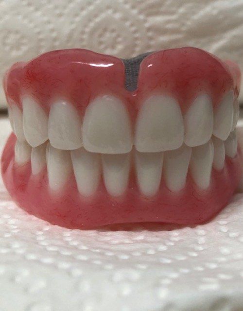 3D Sample of Implant  Immediate Denture — Burleigh Denture Clinic in Burleigh Heads, QLD