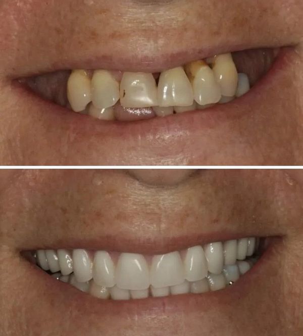 Full Denture — Burleigh Denture Clinic in Burleigh Heads, QLD